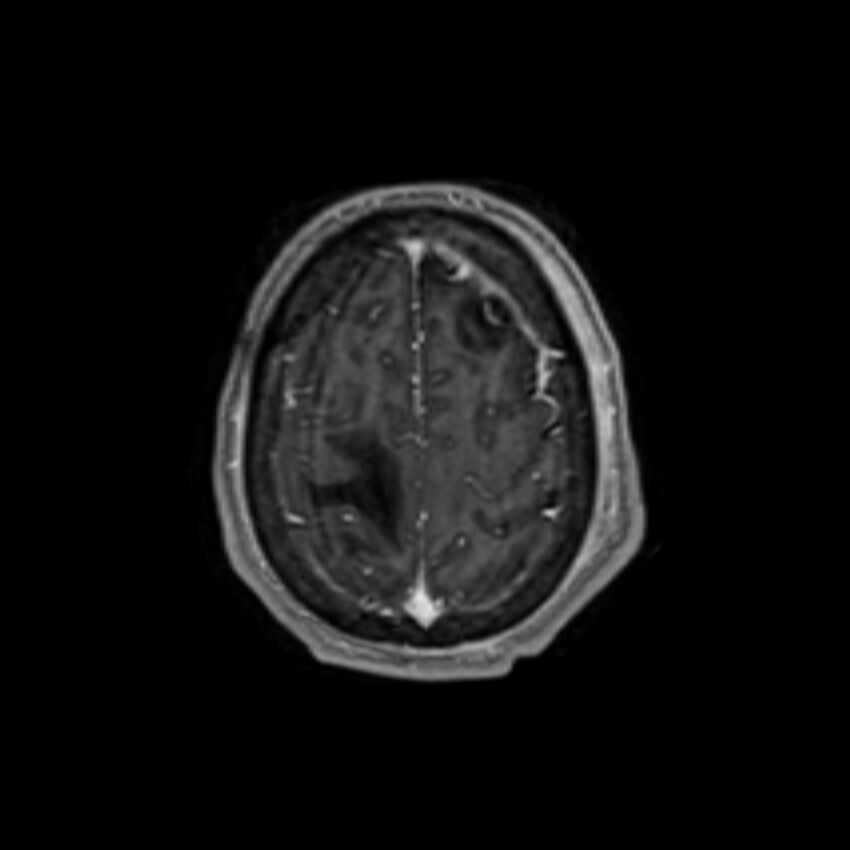 Brain abscess complicated by intraventricular rupture and ventriculitis (Radiopaedia 82434-96577 Axial T1 C+ 61).jpg
