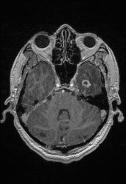 File:Brain abscess with ventriculitis (Radiopaedia 85703-101495 Axial T1 C+ 54).jpg