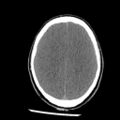 Brain death (Radiopaedia 78597-91360 Axial non-contrast 43).jpg