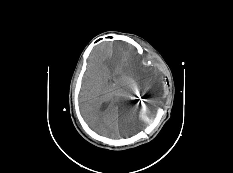 File:Brain injury by firearm projectile (Radiopaedia 82068-96087 B 112).jpg
