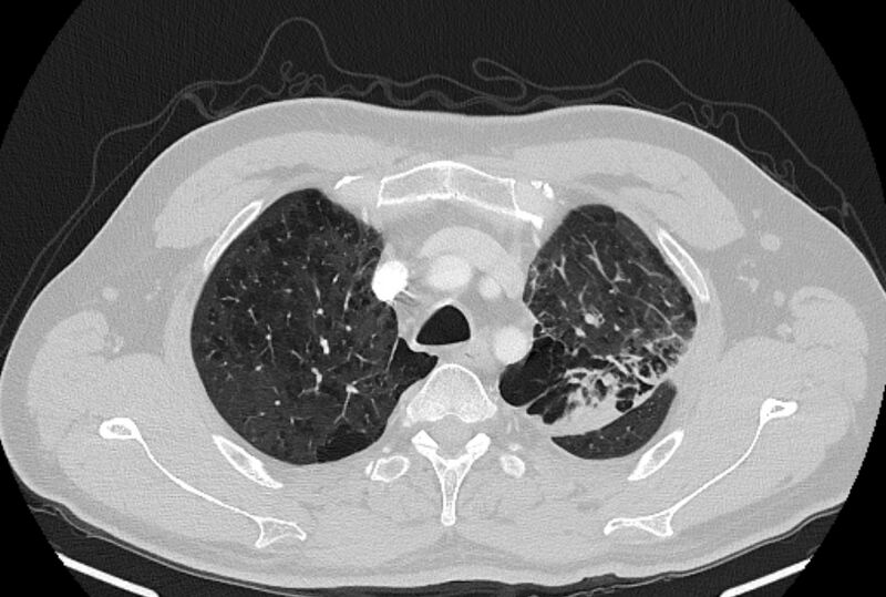 File:Brain metastases - lung cancer primary (Radiopaedia 75060-86116 Axial lung window 10).jpg