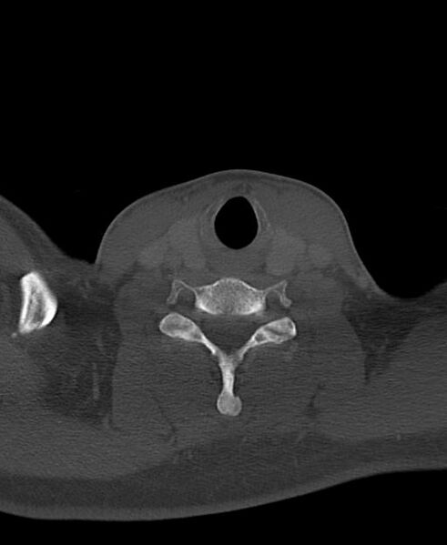 File:Branchial cleft cyst (Radiopaedia 31167-31875 Axial bone window 54).jpg
