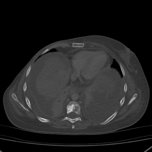 File:Breast cancer metastases - hepatic and skeletal (Radiopaedia 34201-35461 Axial bone window 26).jpg