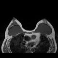 Breast implants - MRI (Radiopaedia 26864-27035 Axial T1 30).jpg