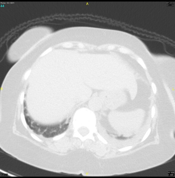 File:Breast primary with lung and bone metastases (Radiopaedia 40620-43228 Axial lung window 44).jpg