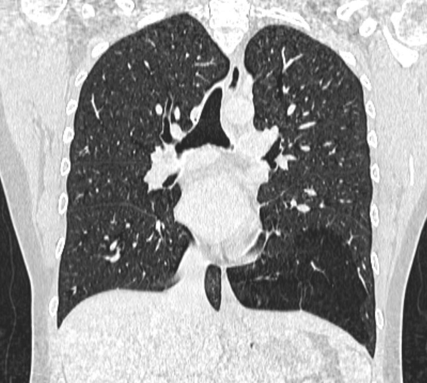 Bronchial atresia (Radiopaedia 50007-55297 Coronal lung window 56).jpg