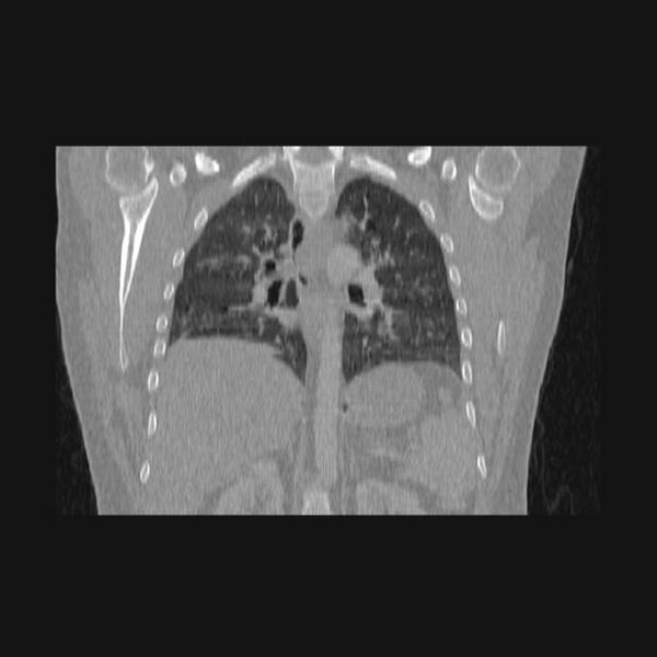 File:Bronchial atresia (Radiopaedia 60685-68439 Coronal lung window 29).jpg