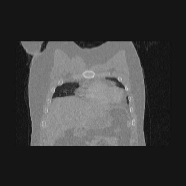 File:Bronchial atresia (Radiopaedia 60685-68439 Coronal lung window 64).jpg