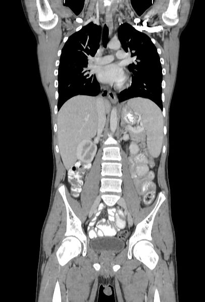 File:Bronchial carcinoid tumor (Radiopaedia 57187-64090 B 53).jpg