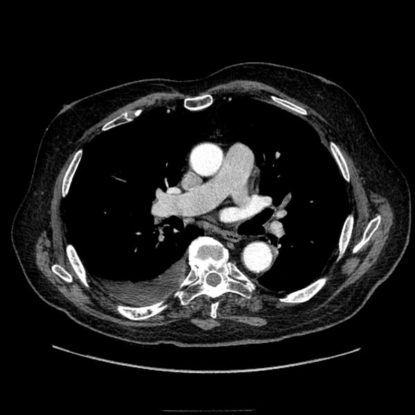 File:Bronchogenic adenocarcinoma and pulmonary embolism (Radiopaedia 9097-9806 D 31).jpg