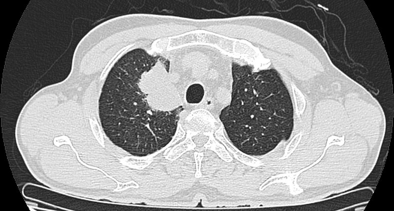 File:Bronchogenic carcinoma with superior vena cava syndrome (Radiopaedia 36497-38054 Axial lung window 23).jpg