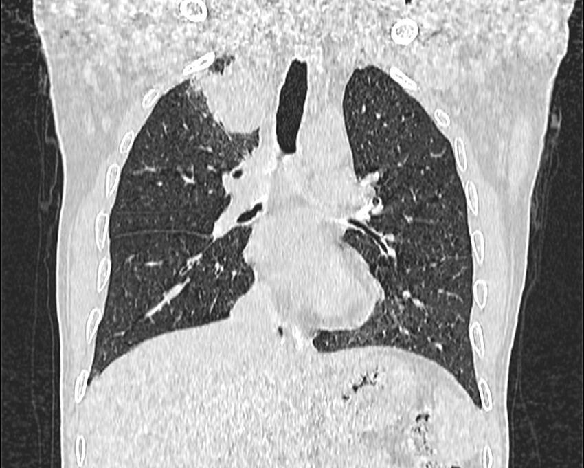 Bronchogenic carcinoma with superior vena cava syndrome (Radiopaedia 36497-38054 Coronal lung window 37).jpg