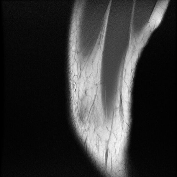 File:Bucket-handle meniscus tear (Radiopaedia 65700-74809 Sagittal T1 2).jpg