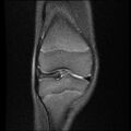 Bucket handle tear - lateral meniscus (Radiopaedia 72124-82634 Coronal PD fat sat 6).jpg