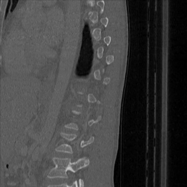 File:Bulging of paraspinal line in traumatic thoracal spinal compression fracture (Radiopaedia 29221-35872 Sagittal bone window 46).jpg