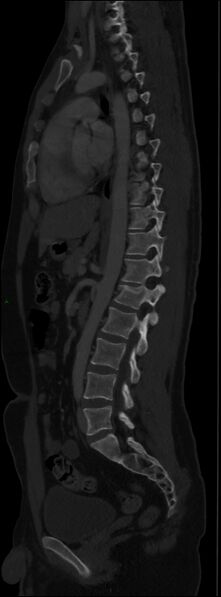 File:Burst fracture (Radiopaedia 83168-97542 Sagittal bone window 72).jpg