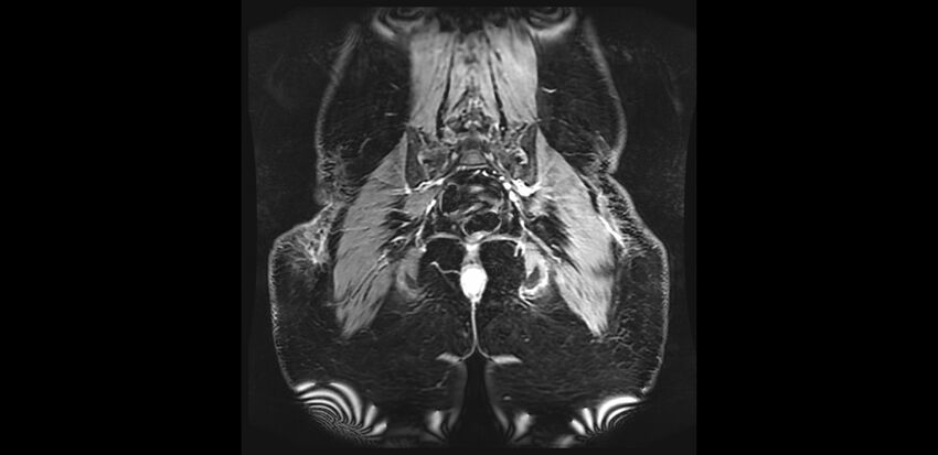 Buttock filler complications (Radiopaedia 63497-72115 Coronal T1 C+ 41).jpg