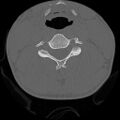 C5 facet fracture (Radiopaedia 58374-65499 Axial bone window 46).jpg