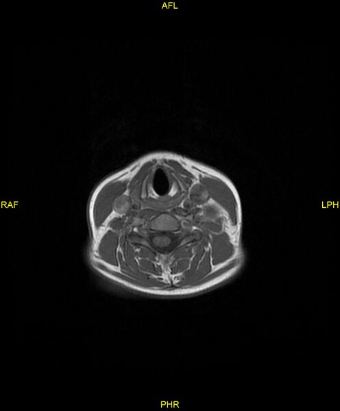 File:C5 nerve sheath tumor (Radiopaedia 85777-101596 Axial T1 15).jpg
