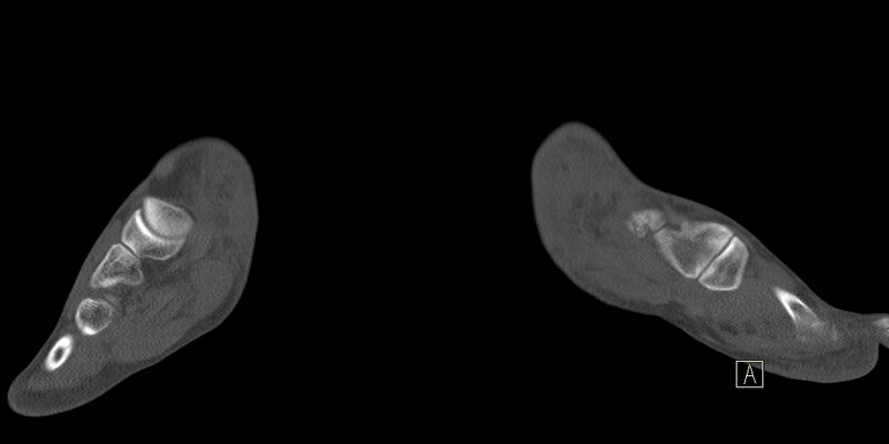 File:Calcaneal fractures with associated L2 burst fracture (Radiopaedia 71671-82041 Coronal bone window 31).jpg