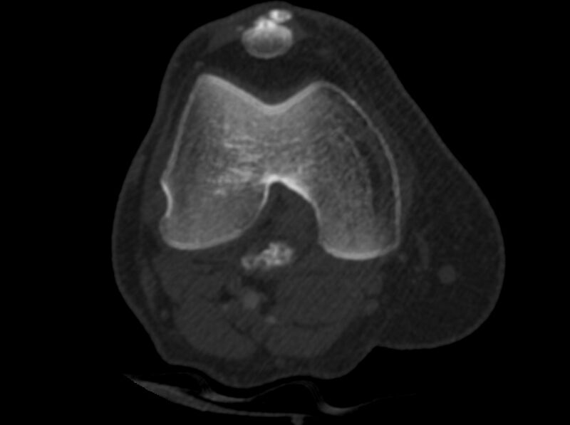 File:Calcified hematoma - popliteal fossa (Radiopaedia 63938-72763 C 5).jpg