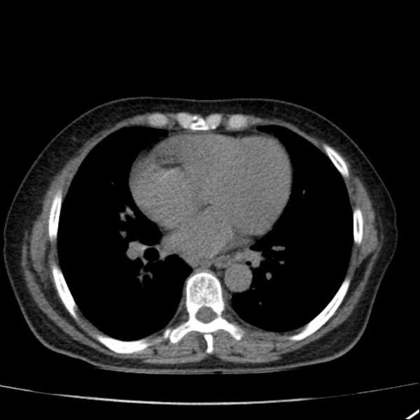 File:Calcified hepatic hydatid cyst (Radiopaedia 26872-27046 Axial non-contrast 3).jpg