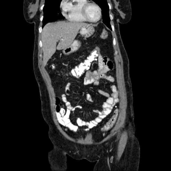 File:Calcified hydatid cyst of the liver (Radiopaedia 21212-21112 D 5).jpg