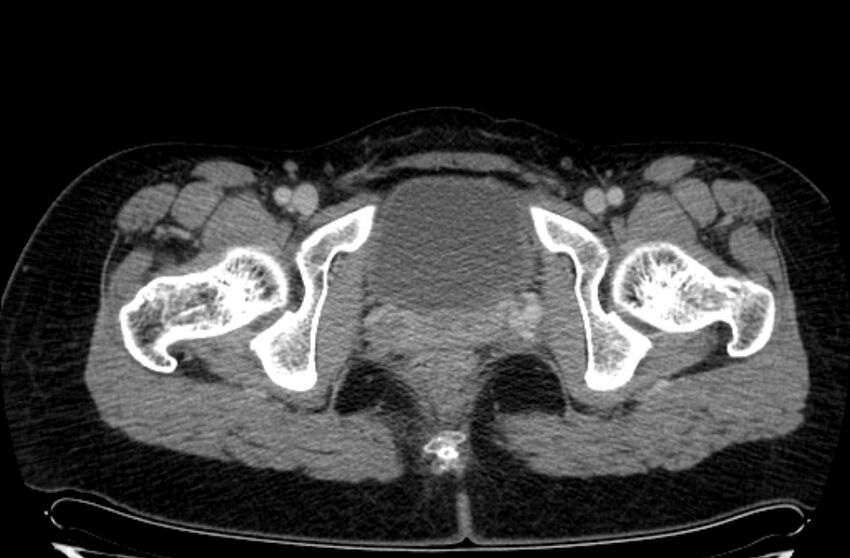 Cannonball metastases - uterine choriocarcinoma (Radiopaedia 70137-80174 A 55).jpg