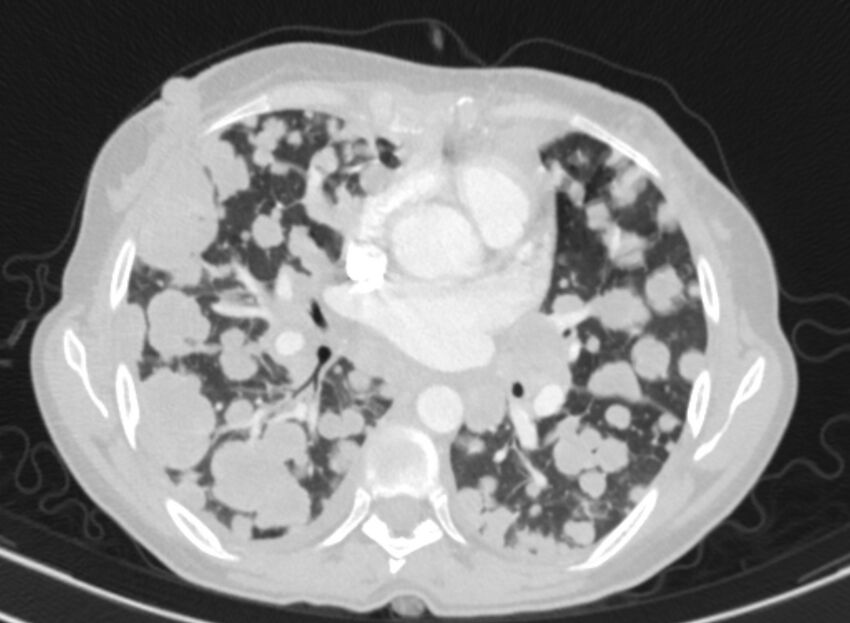 Cannonball metastases from breast cancer (Radiopaedia 91024-108569 Axial lung window 51).jpg