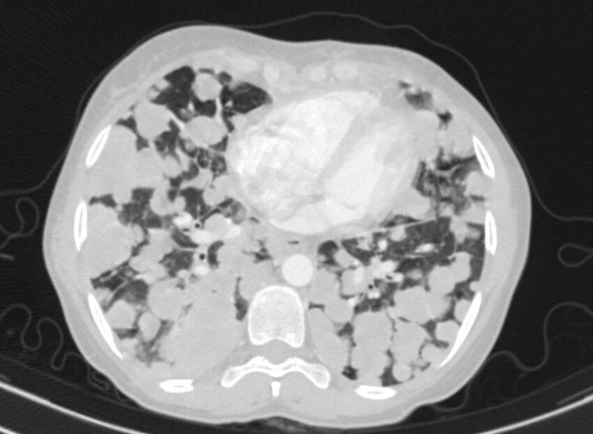 Cannonball metastases from breast cancer (Radiopaedia 91024-108569 Axial lung window 67).jpg