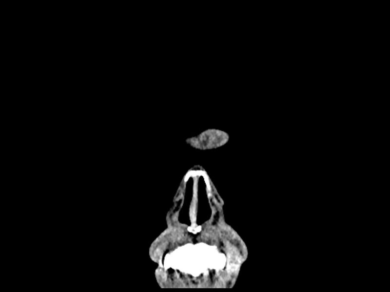 File:Capillary hemangioma of the orbit (Radiopaedia 44610-48358 B 4).jpg