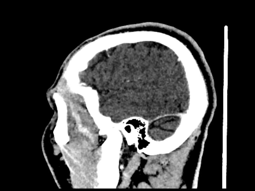 Capillary hemangioma of the orbit (Radiopaedia 44610-48358 C 115).jpg