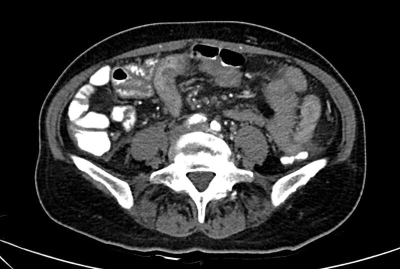 File:Carcinoid mesenteric tumor complicated by chylous ascites (Radiopaedia 76312-88926 A 45).jpg
