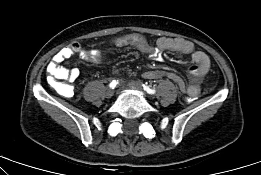 Carcinoid mesenteric tumor complicated by chylous ascites (Radiopaedia 76312-88926 A 48).jpg