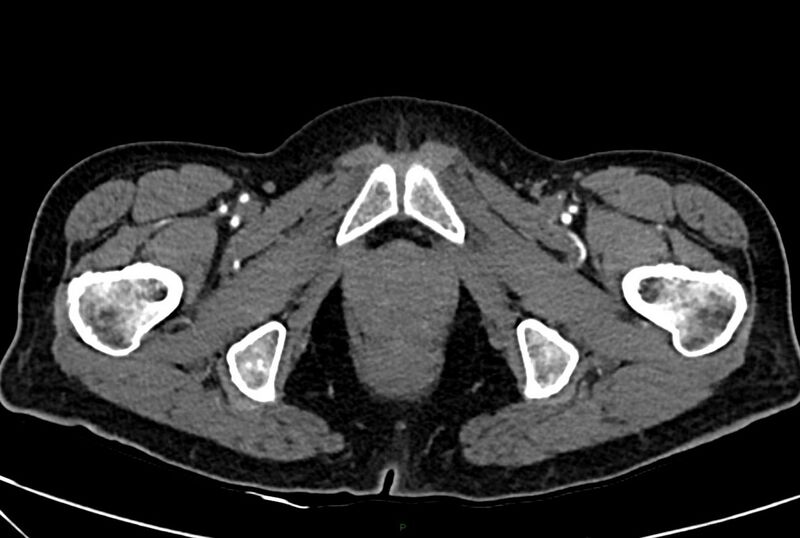 File:Carcinoid mesenteric tumor complicated by chylous ascites (Radiopaedia 76312-88926 A 81).jpg