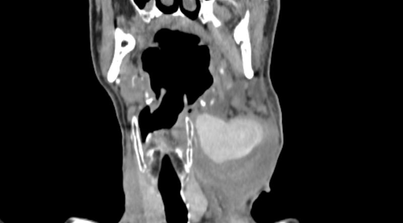 File:Carotid artery pseudoaneurysm (Radiopaedia 84030-99259 D 35).jpg