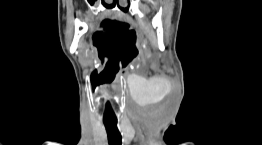 Carotid artery pseudoaneurysm (Radiopaedia 84030-99259 D 35).jpg