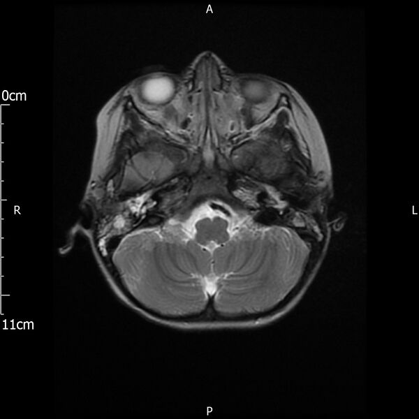 File:Cavernous sinus thrombosis (Radiopaedia 79414-92512 Axial T2 6).jpg
