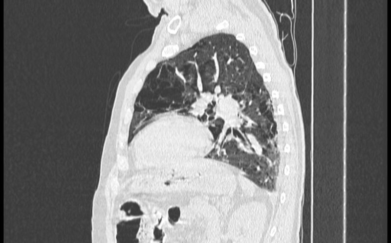 File:Cavitating bronchogenic carcinoma (Radiopaedia 44489-48162 Sagittal lung window 45).jpg