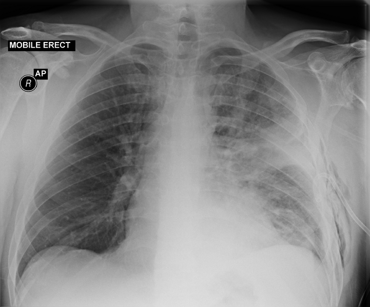 File:Cavitating pneumonia complicated by pneumothorax (Radiopaedia 48149-52991 Frontal 1).png