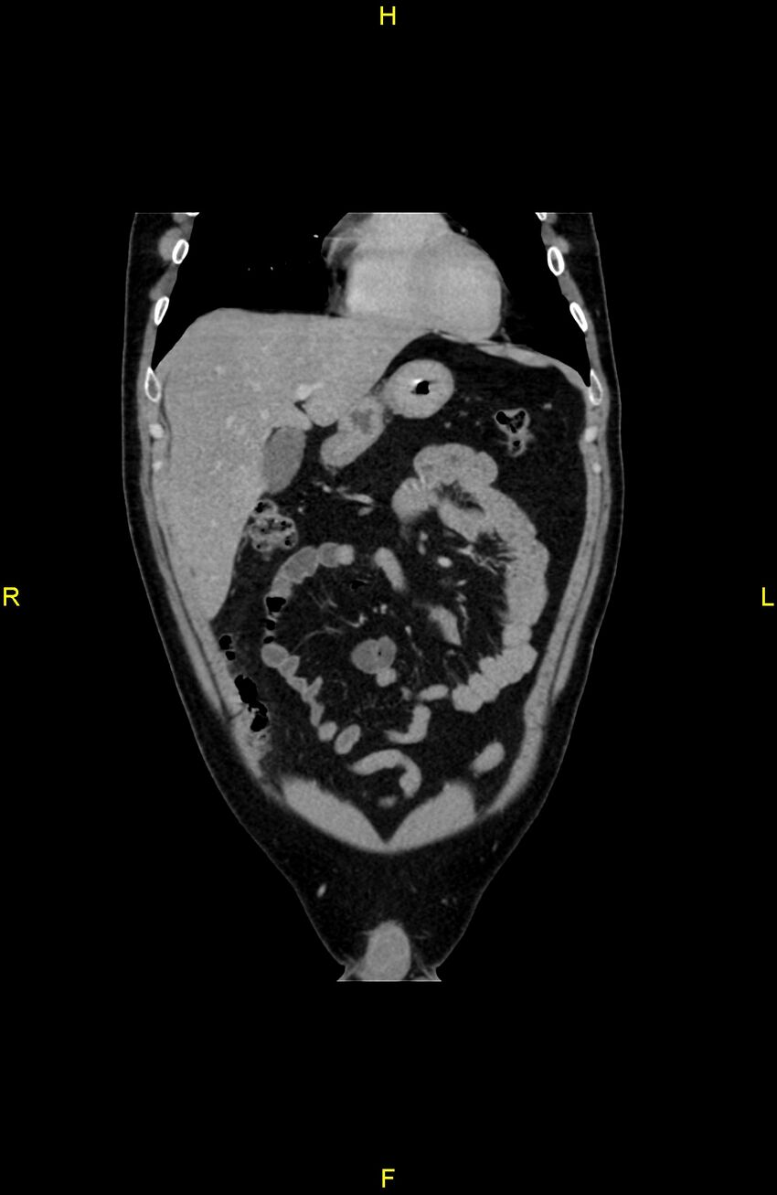 Cecal epiploic appendagitis (Radiopaedia 86047-102164 B 26).jpg