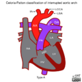 Celoria-Patton classification of interrupted aortic arch (illustration) (Radiopaedia 51881-57708 B 1).png