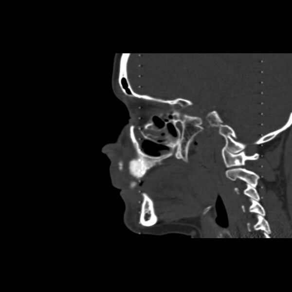 File:Cemento-ossifying fibroma (Radiopaedia 21243-21149 Sagittal bone window 11).jpg