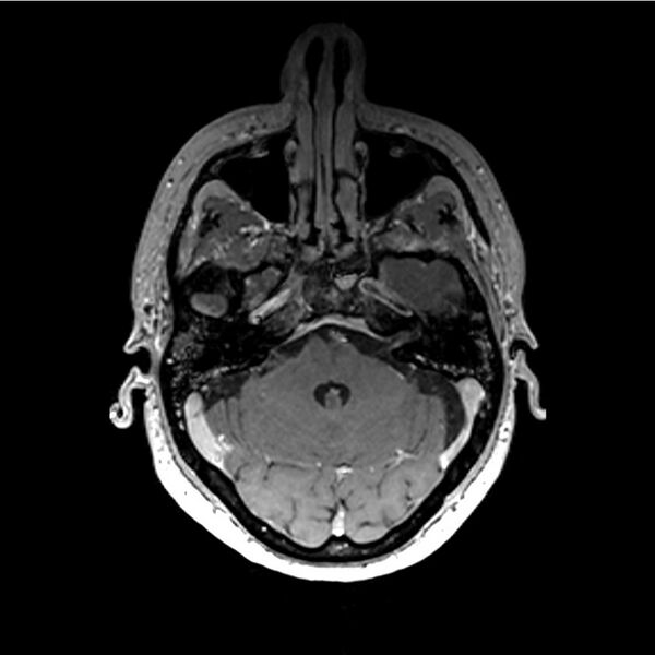 File:Central base of skull meningioma (Radiopaedia 53531-59549 Axial T1 C+ 4).jpg
