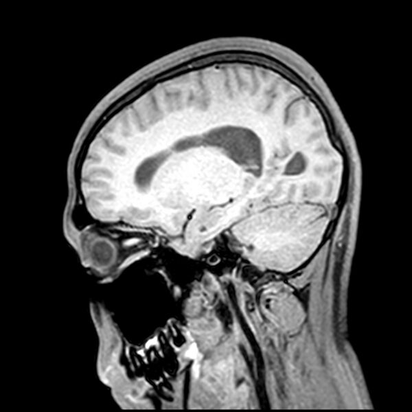 File:Central neurocytoma (Radiopaedia 79320-92380 Sagittal T1 93).jpg