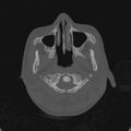 Cerebellar abscess secondary to mastoiditis (Radiopaedia 26284-26413 Axial bone window 1).jpg