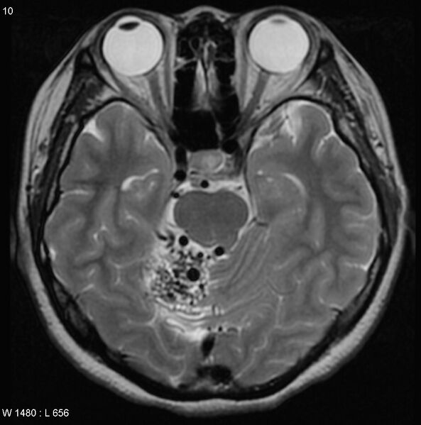 File:Cerebellar arteriovenous malformation (Radiopaedia 5220-6988 Axial T2 6).jpg