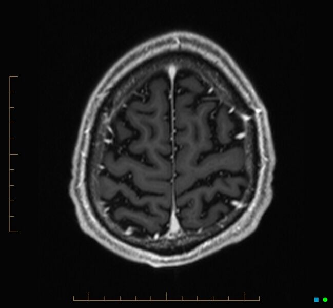 File:Cerebellar gangliocytoma (Radiopaedia 65377-74422 Axial T1 C+ 125).jpg