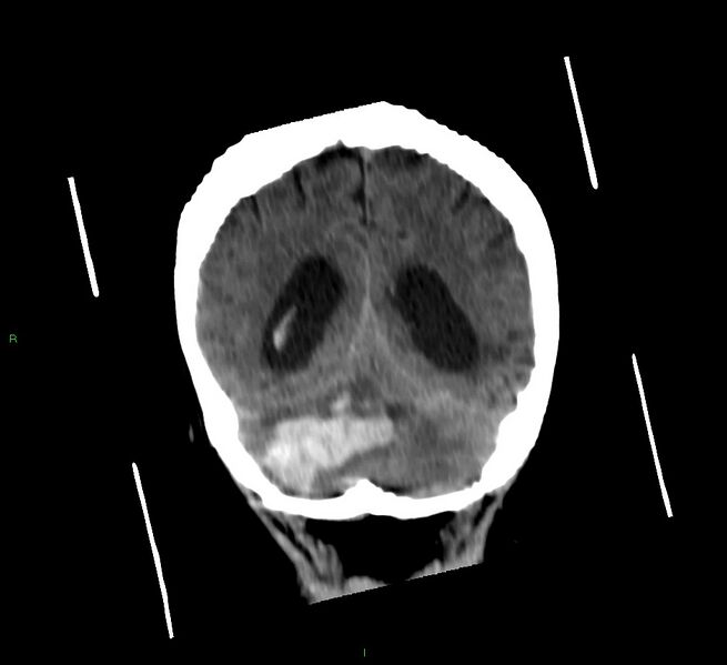 File:Cerebellar hemorrhage (Radiopaedia 58792-66026 Coronal non-contrast 22).jpg