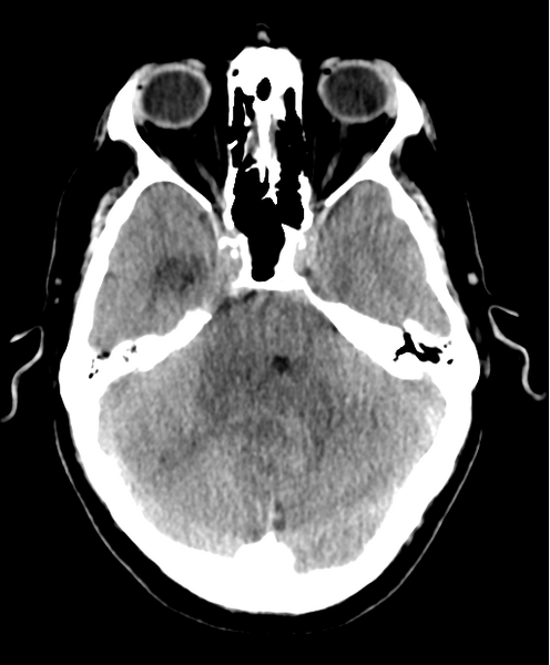 File:Cerebellar metastasis from lung adenocarcinoma (Radiopaedia 86690-102828 Axial non-contrast 9).png
